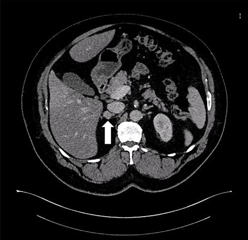 Axial CT of the abdomen showing the right adrenal mass in Patient 2 (white arrow).