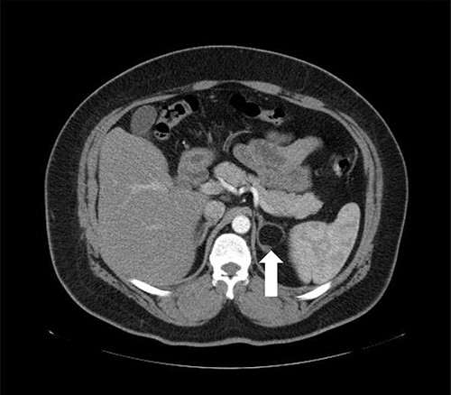 Axial CT of the abdomen showing the left adrenal mass in Patient 3 (white arrow).