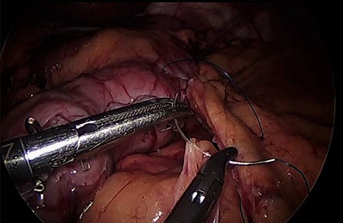 Omentopexy after gastrectomy.