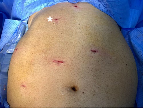 Port placement in Patient 2. The port marked with white star is an additional/optional port for better assistance in LRA.