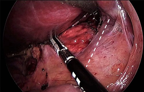 The right adrenal gland next to the IVC (dashed line).
