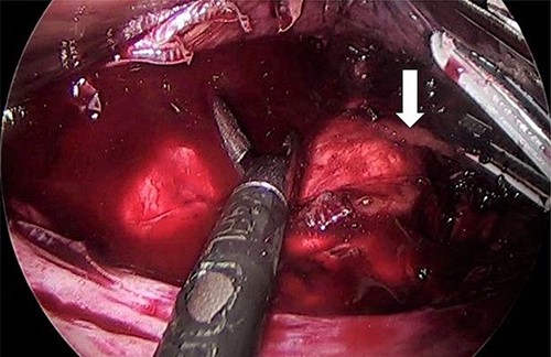 Right adrenal vein (white arrow).
