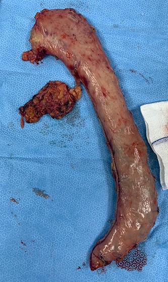 The extracted gastric sleeve and the right adrenal gland.