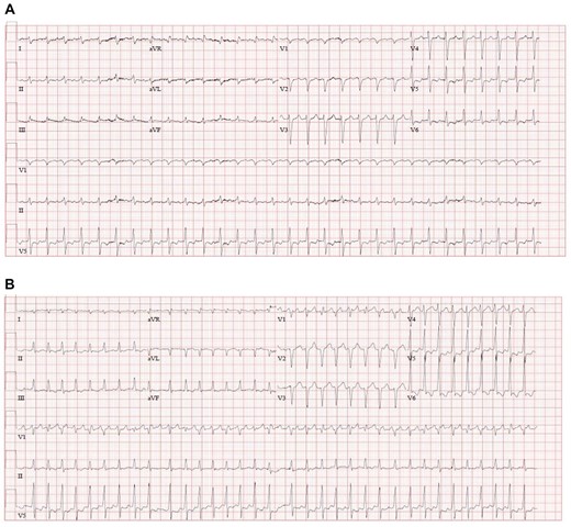 (A) ECG on admission (case 1). (B) ECG on admission (case 2).
