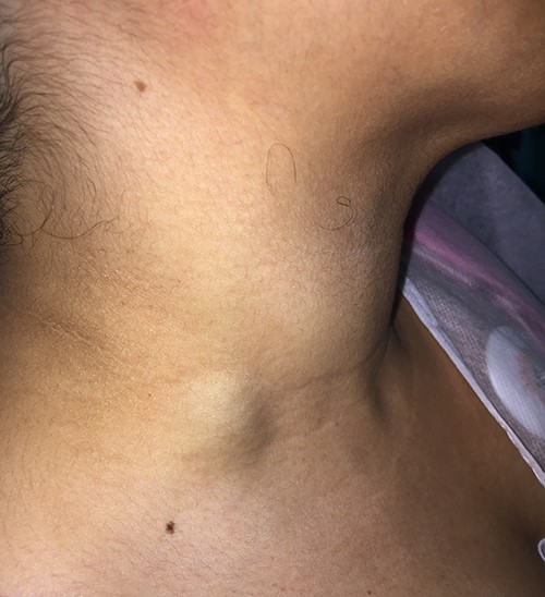 A 27-year-old woman presented with a lump at the right supraclavicular region.