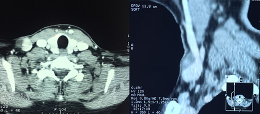 Axial and coronal multidetector CT images following intravenous contrast administration showing the saccular aneurysm arising from the external jugular vein.