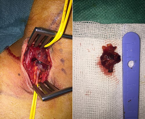 A macroscopic view of the removed right external jugular vein.