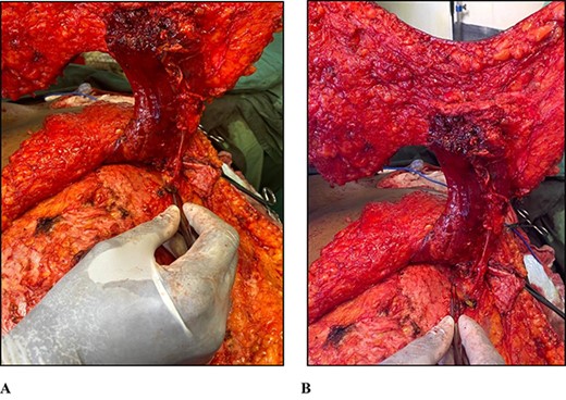 (A) Photograph of forceps pointing to the perforating vascular pedicle arising from the left transversus abdominis muscle and supplying the rectus abdominis muscle. (B) Photograph of forceps pointing to the left transversus abdominis muscle.