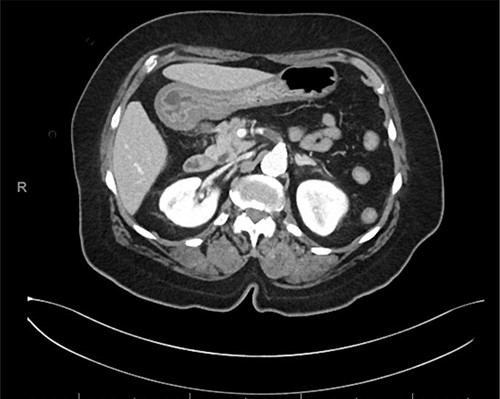 CT abdomen and pelvis with IV contrast, axial image of 1.7 cm occlusive thrombus of proximal SMA.