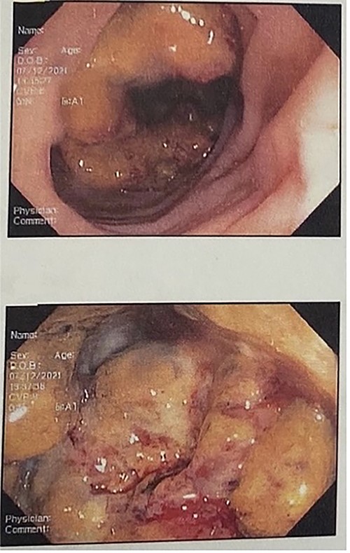 Colonoscopy shows large, necrotic, obstructive, ulcerated friable mass starting ~10 cm from the anal verge, multiple biopsies obtained at the rectosigmoid junction.