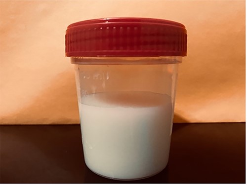 Sample of typical chylous ascites displaying cloudy and milky fluid in appearance.
