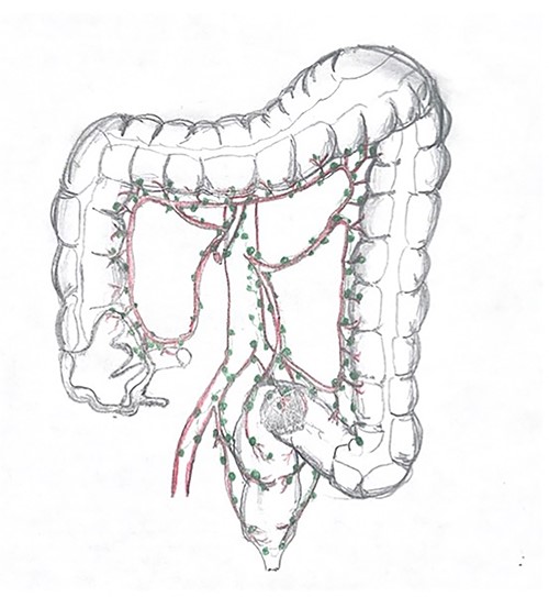 Drawing representation of the lymphatic system in large colon.