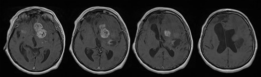 Brain MRI scans revealed an irregular expansive multicenter process located in the basal ganglia, frontobasal and in the area of the frontal operculum left and frontotemporal right with extensive vasogenic edema of the left frontal and parietal lobe and a compressive effect on the left lateral and III ventricle; after the administration of intravenous contrast, the process showed heterogeneous enhancement. Ventricular system was dilated with sign of transependymal edema.