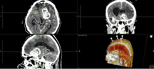 Two separate trajectories were planned using RONNAplan software, for brain biopsy and for EVD implantation. The plan is presented in three planes with 3d reconstruction model in right lower quadrant. Orange trajectory is for brain biopsy, whereas grey one is for EVD implantation.