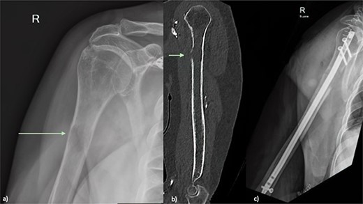 (a) Plain radiograph of the right humerus demonstrating a lucent lesion in the proximal humerus with cortical destruction indicated by green arrow (b) Sagittal CT of the right humerus showing a proximal humeral lesion with breach of the anterior cortex (green arrow) at high risk of pathological fracture (c) plain radiograph Day 1 post prophylactic intramedullary nail of right humerus.