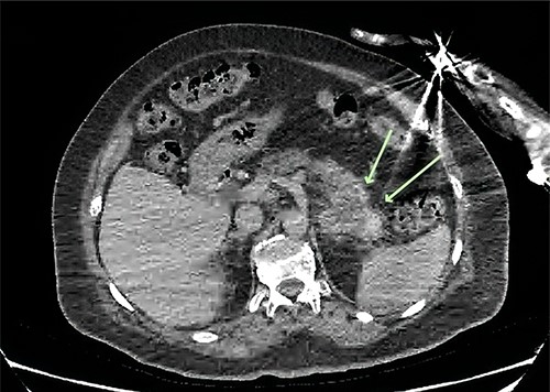 Axial CT of the abdomen demonstrating a necrotic mass centred in the tail of the pancreas measuring 57 × 43 mm (green arrows).