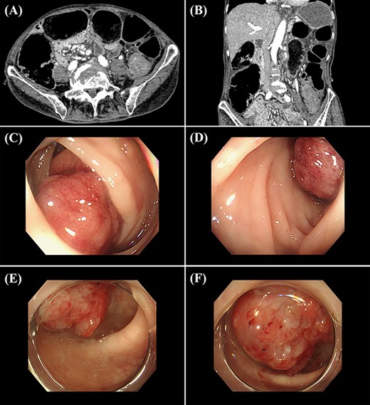(A and B) abdominal CT shows a colonic obstruction with a transition at the level of the sigmoid colon with a thick wall (A, axial view; B, coronal view); (C and D) colonoscopy shows a lesion similar to a Bormann Type I tumour in the sigmoid colon; (E and F) 3 years later, colonoscopy shows the tumour in the same location.