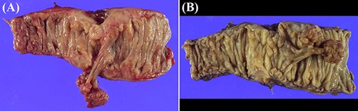 Macroscopic pathological examination demonstrates a sigmoid colon polyp with two heads that were 20 mm in diameter and one stem of 25 mm in length.