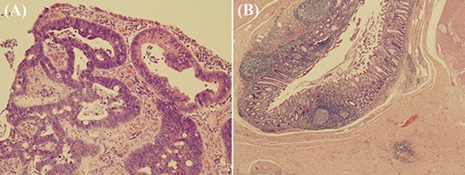 Microscopic pathological findings; (A) in the mucosa of the two heads of the polyp, there is proliferation of atypical villi and tubules with enlarged and stratified nuclei (haematoxylin and eosin stain, original magnification ×100); (B) in the non-tumour area, there are >10 diverticula (pseudodiverticula), some of which show fibrosis and haemorrhage in the subserosal tissue (haematoxylin and eosin stain, original magnification ×20); this finding is consistent with a history of diverticulitis.