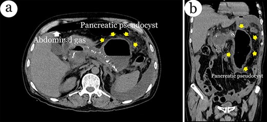 Computerized tomography of the abdomen with intravenous contrast shows a massive pseudocyst within the left side of the abdomen, extraluminal gas and gallstones in axial plane (a) and coronal plane (b).