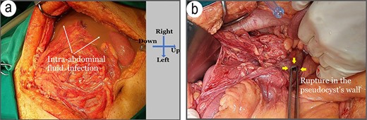 Injuries identified during surgery. (a) A large volume of infected intraperitoneal fluid, (b) a breach in the pseudocyst’s wall filled with a turbid fluid identical to that found in the abdomen (white arrow).