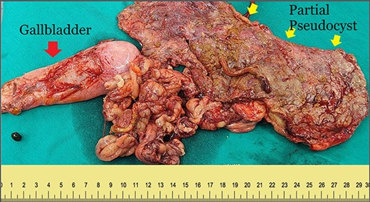 Postoperative specimens included the gallbladder (red arrow), part of the PP wall (yellow arrow) and the great omentum.