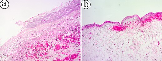 On the micrograph of a partial pancreatic pseudocyst. However, epithelial lining cells of cysts are absent—haemorrhage and oedema in lamina propria. (a, H&E stain, ×50; b, H&E stain, ×50).