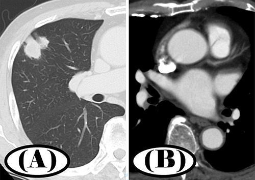 Preoperative chest CT; (A) a 3.0-cm nodule in S3 segment of the right upper lobe was found in pulmonary window setting; (B) contrast-enhanced CT showed no thrombus in the left atrium.