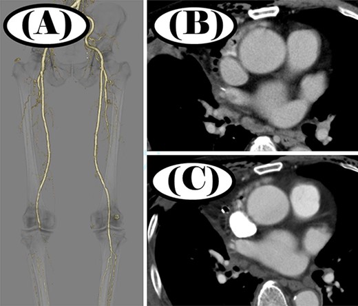 Contrast-enhanced CT before and after thrombectomy; (A) no peripheral vessels were depicted beyond the right popliteal artery before thrombectomy; (B) thrombus was seen in the right superior PVS before thrombectomy; (C) thrombus disappeared in the right superior PVS after thrombectomy.