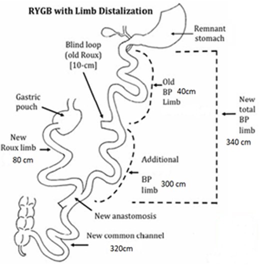 Measures after limb distalization. (Reference images were taken from: Surve, A, Cottam, D. A step-by-step surgical technique video of revision of Roux-en-Y gastric bypass with limb distalization. OBES Surg 31:464–466. Those images were modified in order to explain our procedure).
