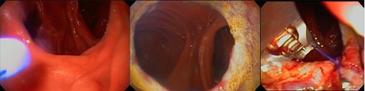 eTOR procedure: (a) view of the GJ anastomosis, (b) APC therapy and (c) eTOR.