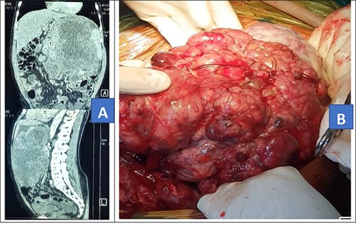 Contrasted abdominal CT scan (A) and intra-operative picture (B) for Patient 1.