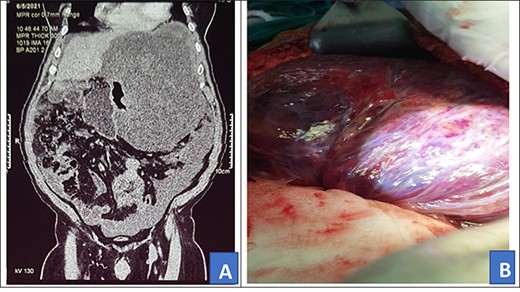 Preoperative abdominal CT scan (A) and intra-operative picture (B) for Patient 2.