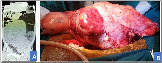 Preoperative abdominal CT scan (A) and intra-operative picture (B) for Patient 3.
