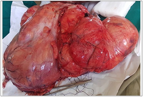 Tumor removed from Patient 3.