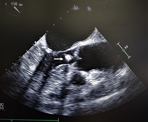 Transesophageal echocardiogram of cardiac amorphous tumor within the LVOT; intraoperative TEE revealed similar findings as a TTE in the outpatient setting; the hyperechoic sphere-like lesion can be identified within the LVOT in the mid-esophageal bicaval view (white arrow); the mass was mobile and nonobstructive to the LVOT; the attachment site was not visualized clearly.