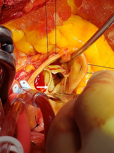 Sphere-like mass identified under the noncoronary cusp of the aortic valve; intraoperatively, the mass was under the noncoronary cusp of the aortic valve; the mass was traced and was originating from the A1 segment of the mitral valve.
