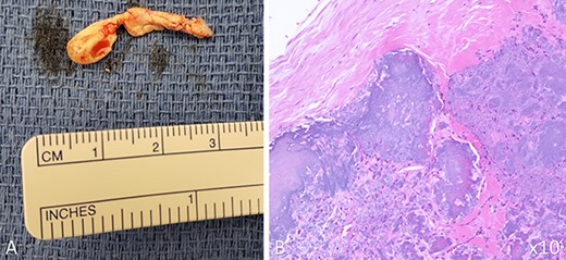 Gross picture and histological slide of CAT; the mass was isolated in two irregular fragments with the following dimensions: 5 × 4 × 3 mm and 22 × 7 × 6 mm (A); histological examination of the mass under 10x magnification (B) (hemolysin and eosin staining) showed nodular calcification in the background of eosinophilic amorphous background; both gross and histological findings were consistent with CAT of the heart.