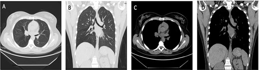 Case 1: (A and B) Lung window showing endo-bronchial lesion at the right bronchus intermedius with air trapping middle and lower lobes. (C and D) Same lesion evident on mediastinal window on both axial and coronal cuts.