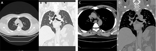 Case 2: panels (A and B) show an intratracheal soft tissue mass just above the carina more toward the left side. (C and D) Same lesion on axial cuts with radiological evidence of infiltration/invading left lateral wall of the trachea.