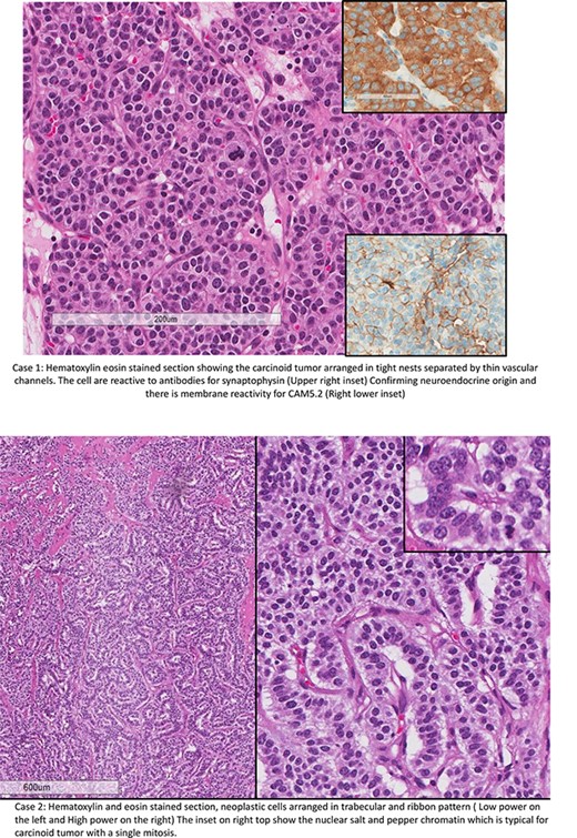 Case 1: hematoxylin eosin stained section showing the carcinoid tumor arranged in tight nests separated by thin vascular channels. The cells are reactive to antibodies for synaptophysin (upper right inset). Confirming neuroendocrine origin and there is membrane reactivity for CAM5.2 (right lower inset). Case 2: hematoxylin and eosin stained section, neoplastic cells arranged in trabecular and ribbon pattern (low power on the left and high power on the right). The inset on right top shows the nuclear salt and pepper chromatin, which is typical for carcinoid tumor with a single mitosis.