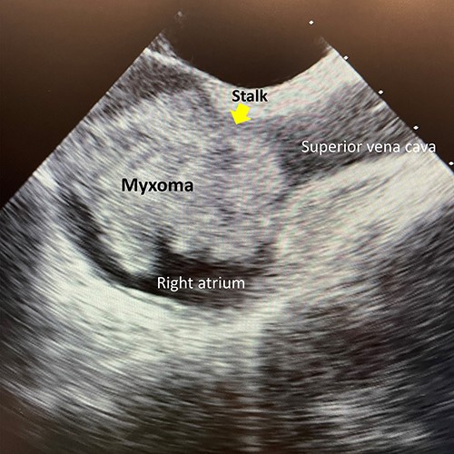 Preoperative transesophageal cardiac echocardiography.