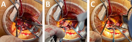 Intraoperative picture. (A) Large right atrial myxoma. (B) Traction suture at myxoma. (C) Resection the stalk of myxoma.