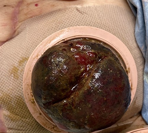 Edematous colostomy 7 days after colonoscopy.