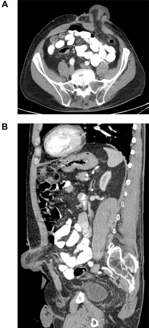 Axial (A) and sagittal (B) CT of the abdomen and pelvis, with IV contrast demonstrating edematous colostomy above the level of the fascia.