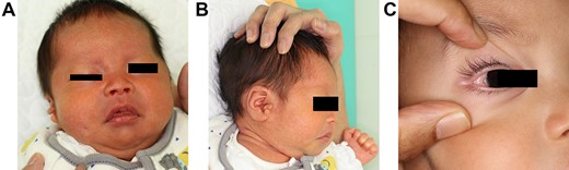 (A) A 2-month-old baby presented a small pit outside of his right oral commissure. The difference between the left and right cheeks was not remarkable. (B) There presented preauricular appendages on his right side. (C) There presented an epibulbar dermoid inside of his right external eye angle.
