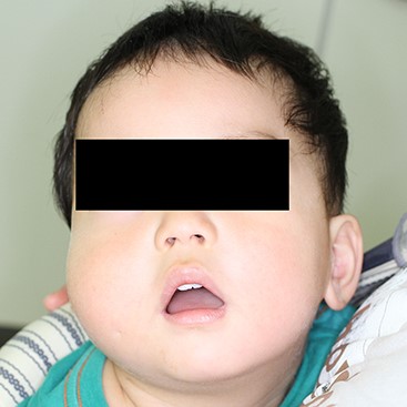 At the age of one and a half, his right cheek was swollen with a slight fever. No discharge from the pit was observed.