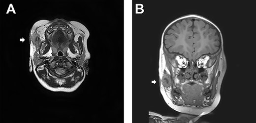 (A) A transverse sT2W mDixon MRI image. A cystic lesion beneath the superficial musculo-aponeurotic system is identified. (B) A coronal section of MRI.