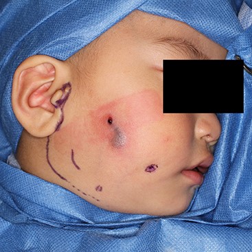 Christal violet ink was injected from the cheek pit. The ink came out from the perforated hole. An elongated retro-mandibular incision was designed.