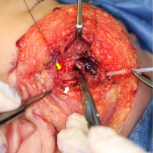 The yellow arrow points one of the buccal branches of facial nerve. The white arrow points Steensen’s duct. C: cyst, F: fistula, canulated with a plastic outer tube of an intravenous catheter.
